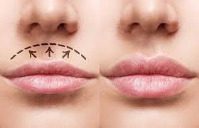 Preenchimento Labial