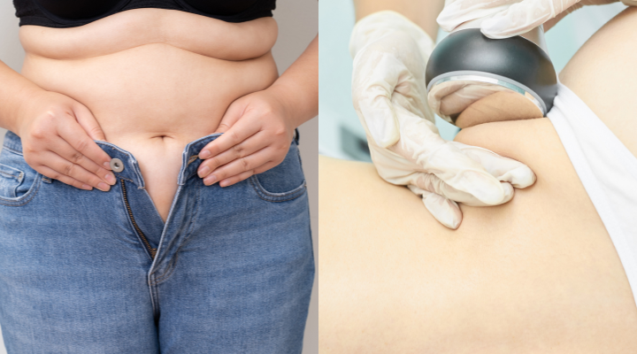 Lipo sem corte